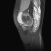 Hemangioma cavernoso en Rodilla