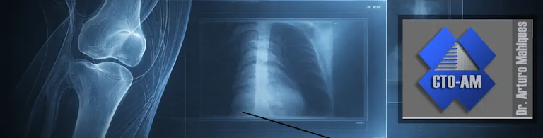 Tumores del aparato locomotor