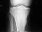 Osteoma osteoide
